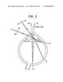 IOL Peripheral Surface Designs to Reduce Negative Dysphotopsia diagram and image