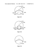 Multifocal Lens Having a Progressive Optical Power Region and a Discontinuity diagram and image