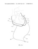 PERICARDIAL INSERTS diagram and image