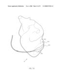 PERICARDIAL INSERTS diagram and image