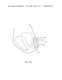 PERICARDIAL INSERTS diagram and image