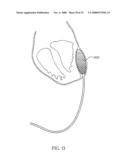 PERICARDIAL INSERTS diagram and image