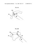 ENDOSCOPIC GUIDE DEVICE diagram and image