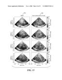 ULTRASONIC TISSUE DISPLACEMENT/STRAIN IMAGING OF BRAIN FUNCTION diagram and image