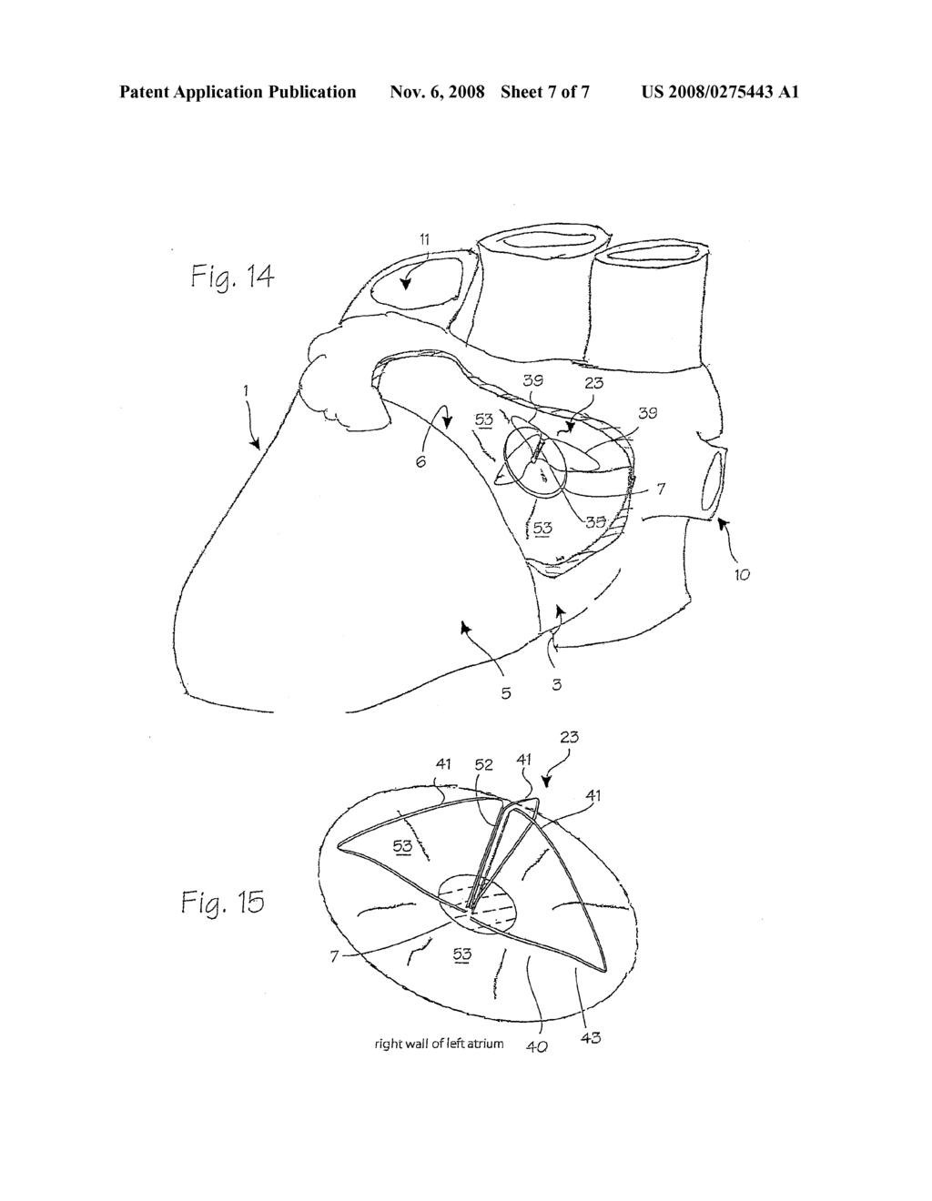 ATRIAL ABLATION CATHETER ADAPTED FOR TREATMENT OF SEPTAL WALL ARRHYTHMOGENIC FOCI AND METHOD OF USE - diagram, schematic, and image 08