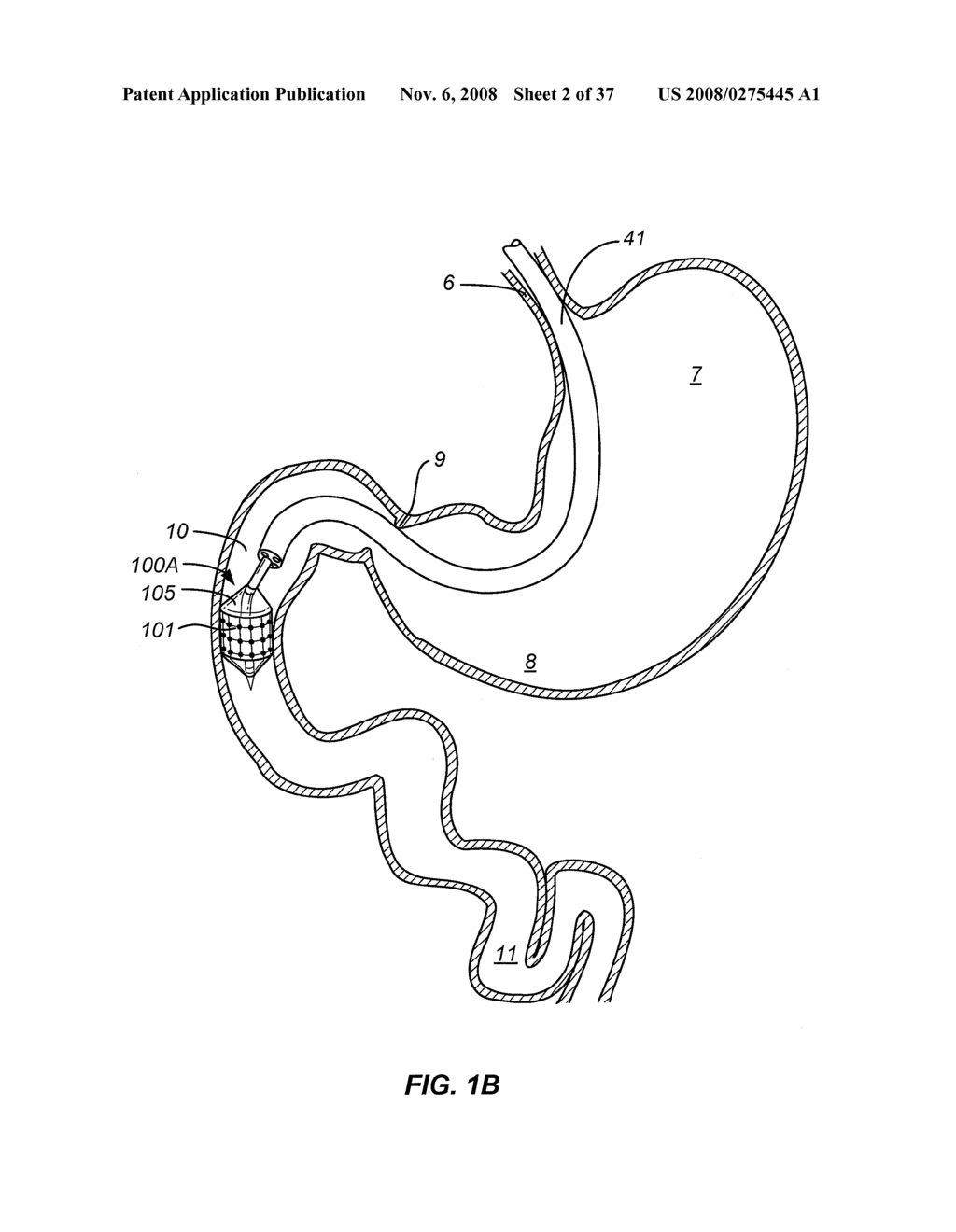 METHOD AND APPARATUS FOR GASTROINTESTINAL TRACT ABLATION FOR TREATMENT OF OBESITY - diagram, schematic, and image 03