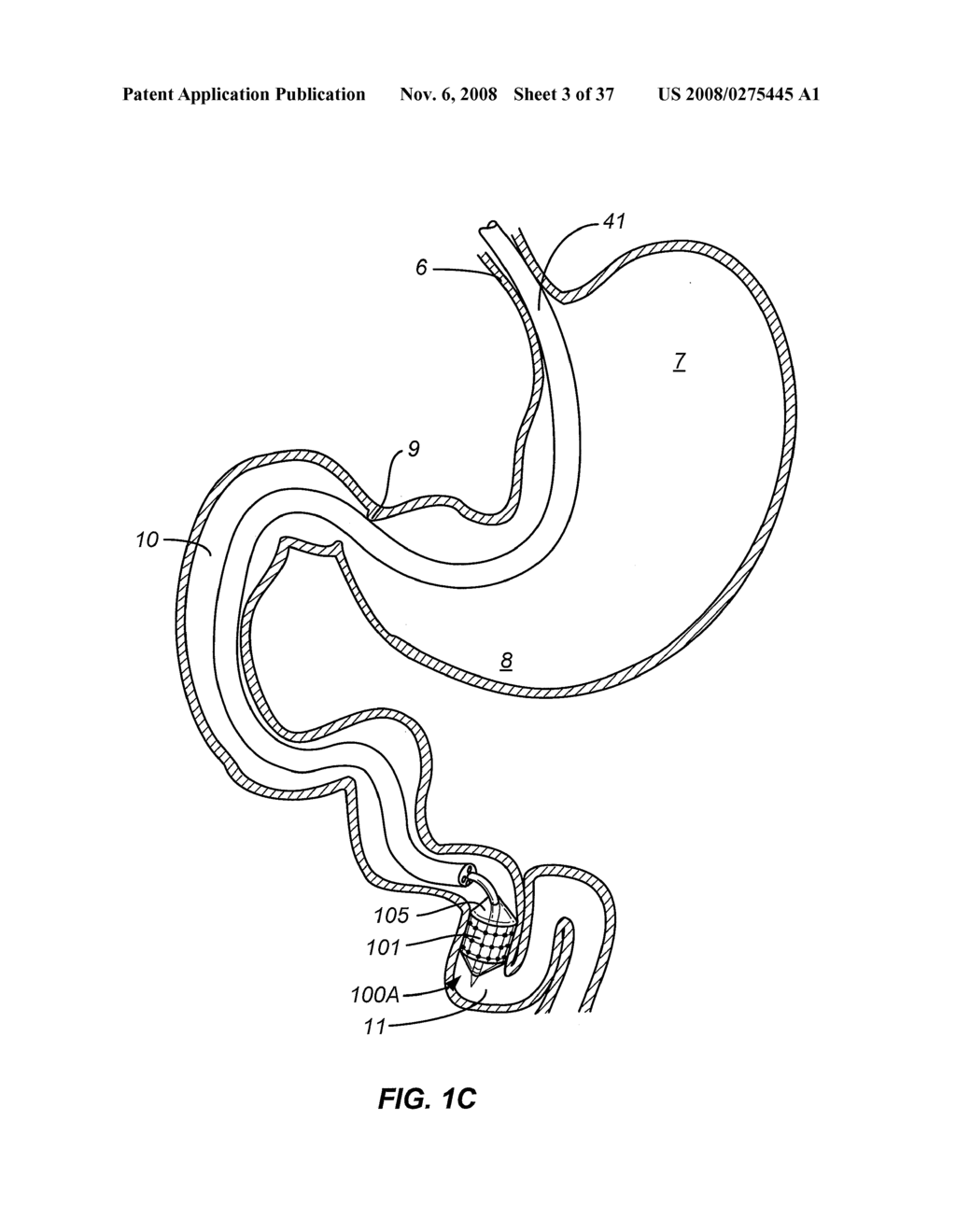 METHOD AND APPARATUS FOR GASTROINTESTINAL TRACT ABLATION FOR TREATMENT OF OBESITY - diagram, schematic, and image 04