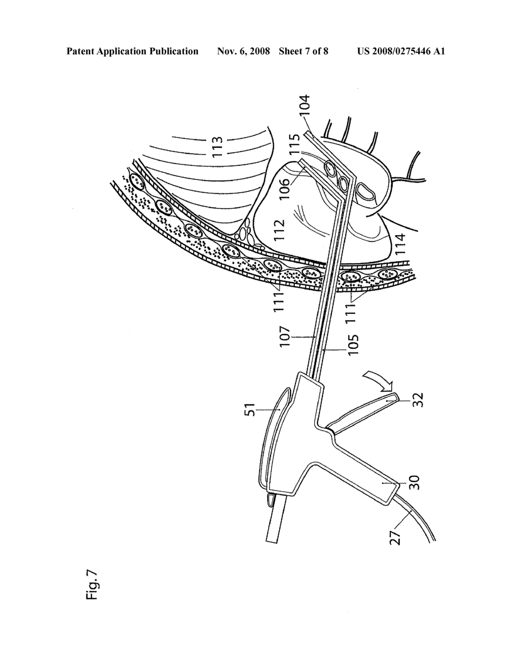 TWO-PIECE JAW FOR BIPOLAR ABLATION DEVICE - diagram, schematic, and image 08