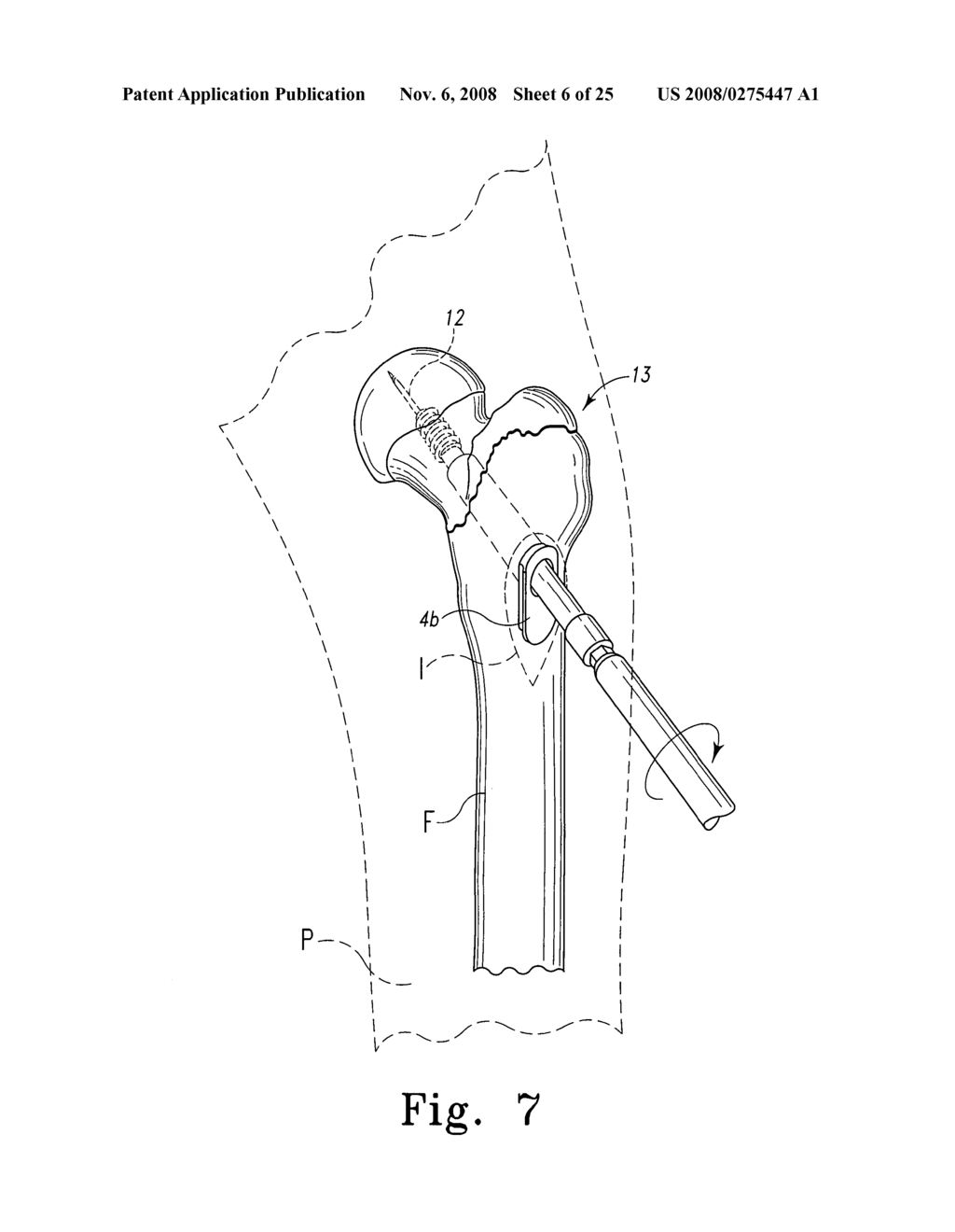 Assembly for minimally invasive reduction of hip fracture - diagram, schematic, and image 07