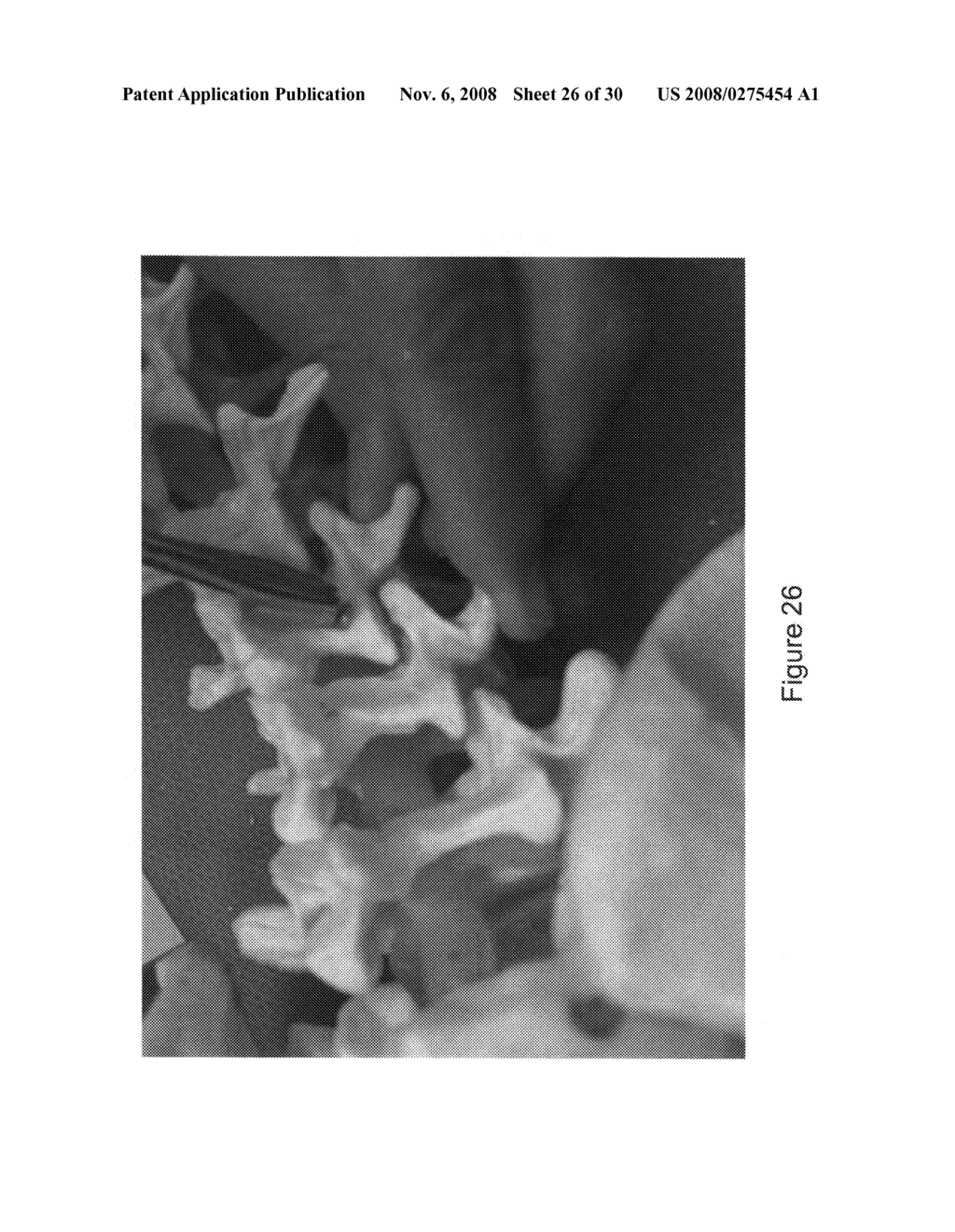 Lumbar pedicular-facet fixation system and instrumentation - diagram, schematic, and image 27