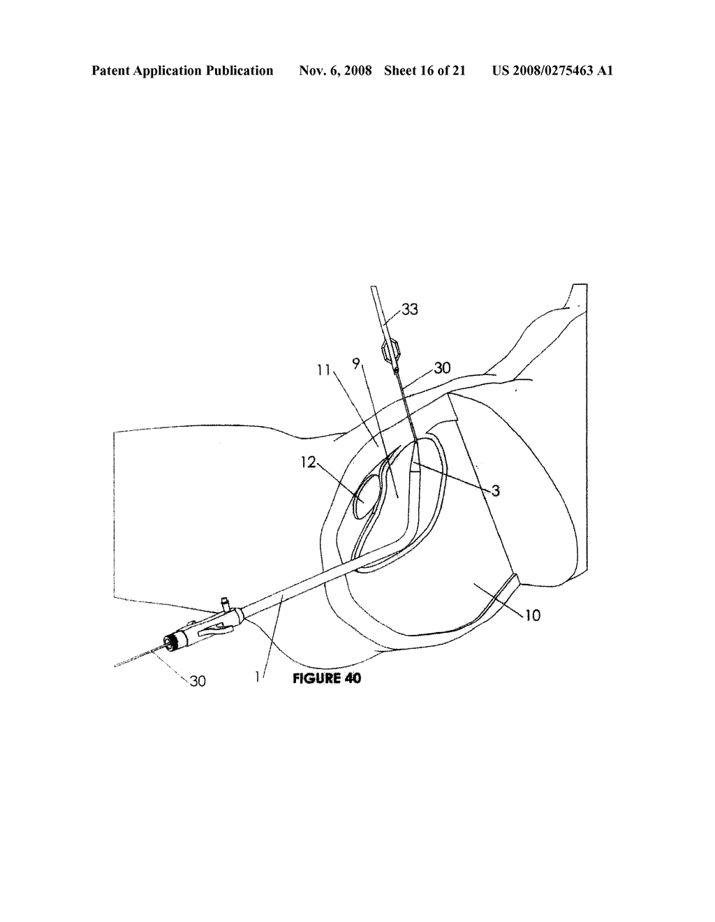 CYSTOTOMY CATHETER CAPTURE DEVICE AND METHODS OF USING SAME - diagram, schematic, and image 17