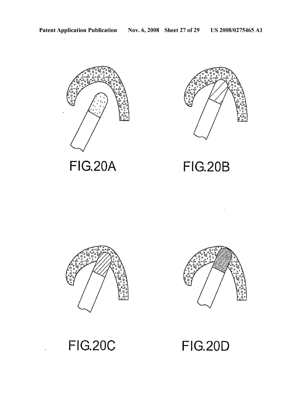 Design of Handle Set for Ablation Catheter with Indicators of Catheter and Tissue Parameters - diagram, schematic, and image 28