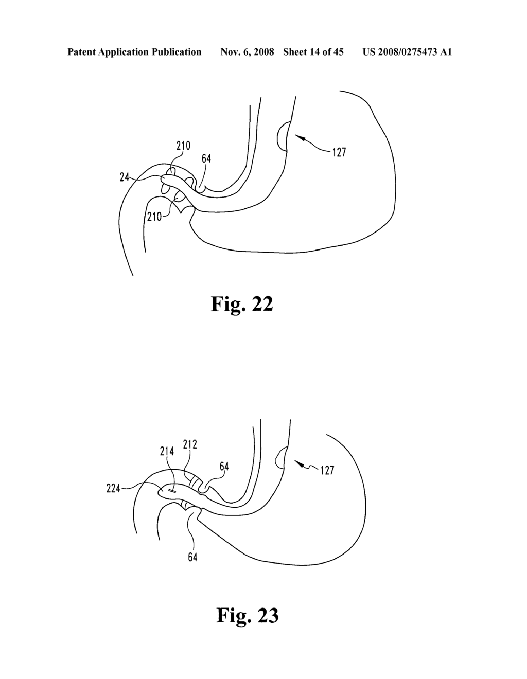 SYSTEMS AND TECHNIQUES FOR MINIMALLY INVASIVE GASTROINTESTINAL PROCEDURES - diagram, schematic, and image 15