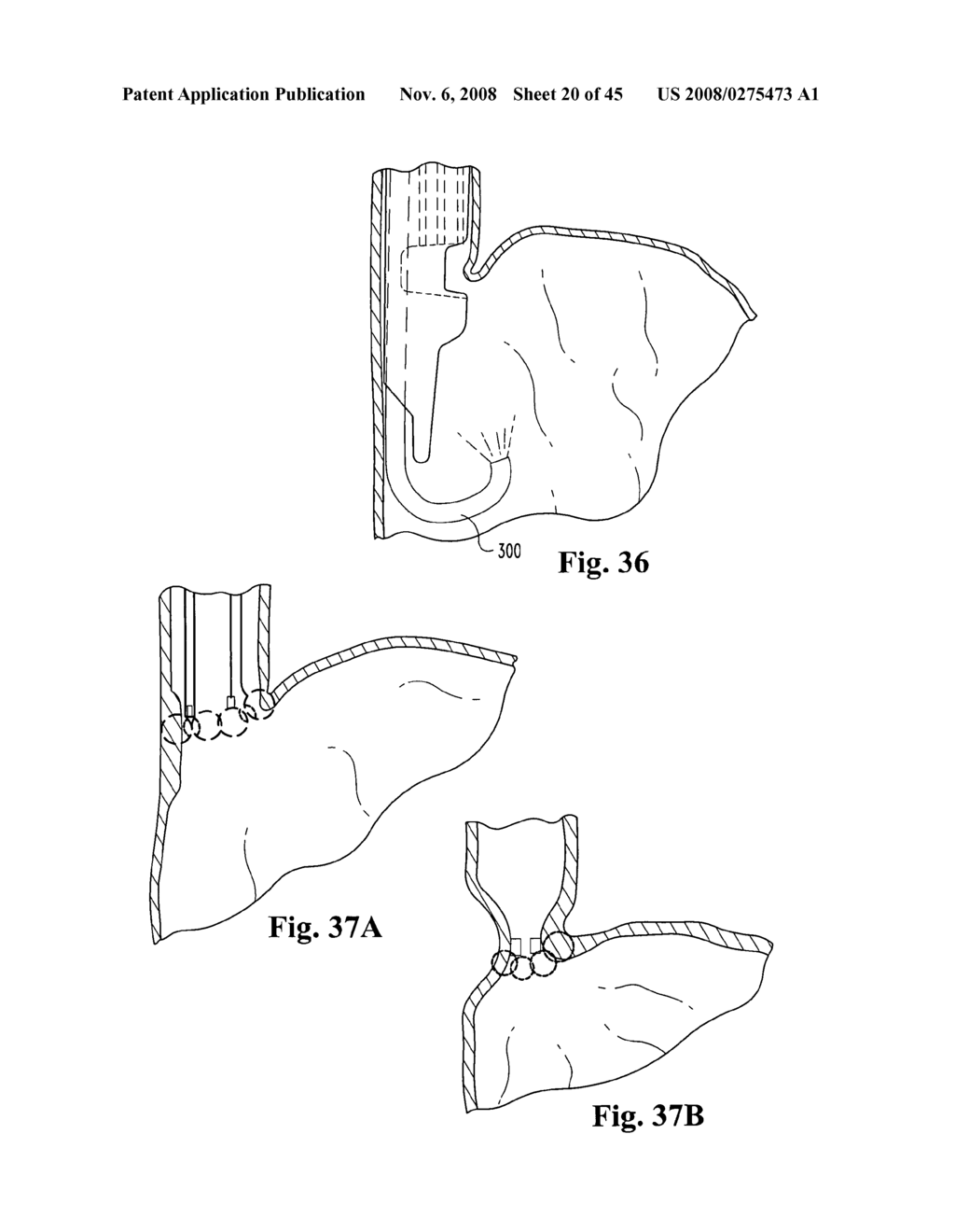 SYSTEMS AND TECHNIQUES FOR MINIMALLY INVASIVE GASTROINTESTINAL PROCEDURES - diagram, schematic, and image 21