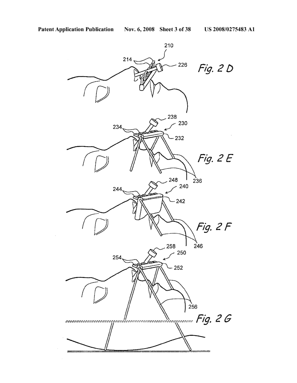 Methods and Apparatus for Treating Disorders of the Ear Nose and Throat - diagram, schematic, and image 04