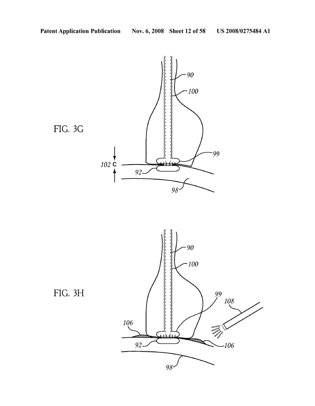 Per Os Placement of Extragastric Devices - diagram, schematic, and image 13