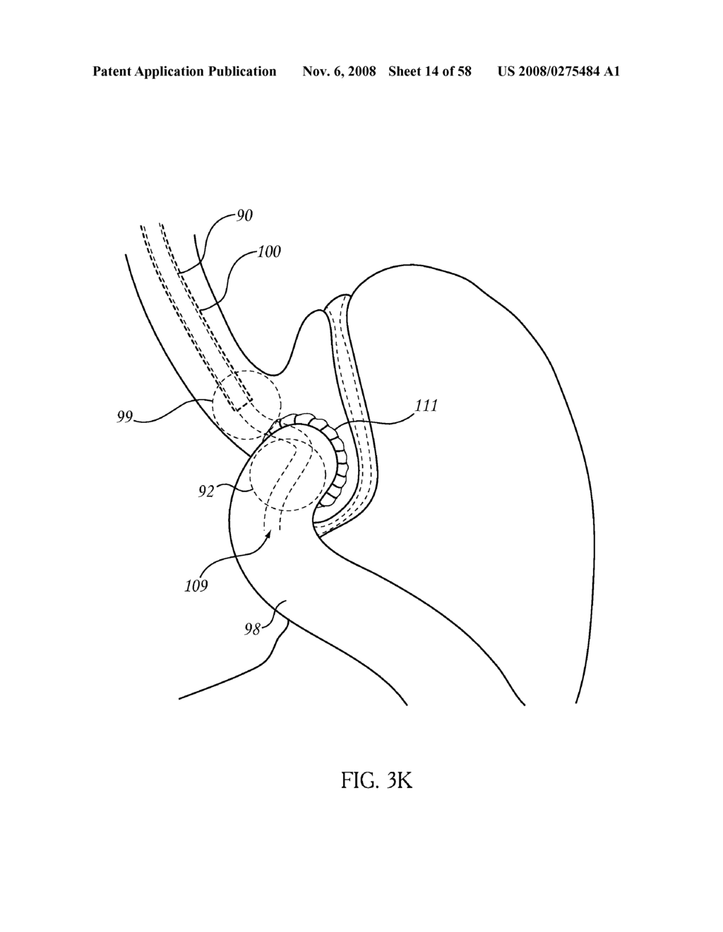 Per Os Placement of Extragastric Devices - diagram, schematic, and image 15