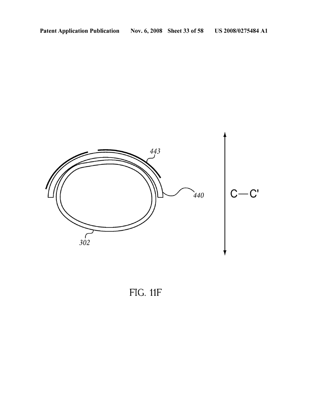 Per Os Placement of Extragastric Devices - diagram, schematic, and image 34