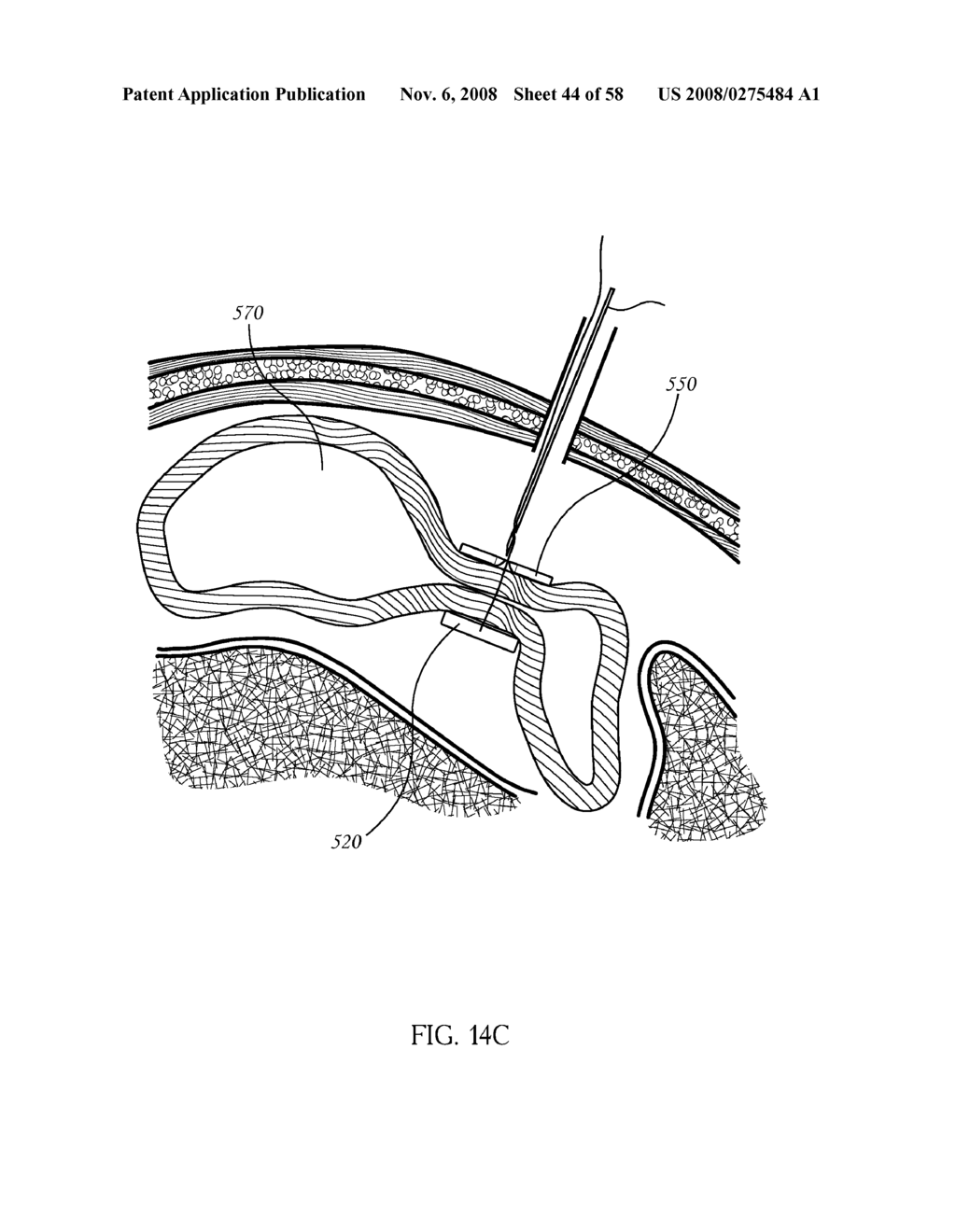 Per Os Placement of Extragastric Devices - diagram, schematic, and image 45