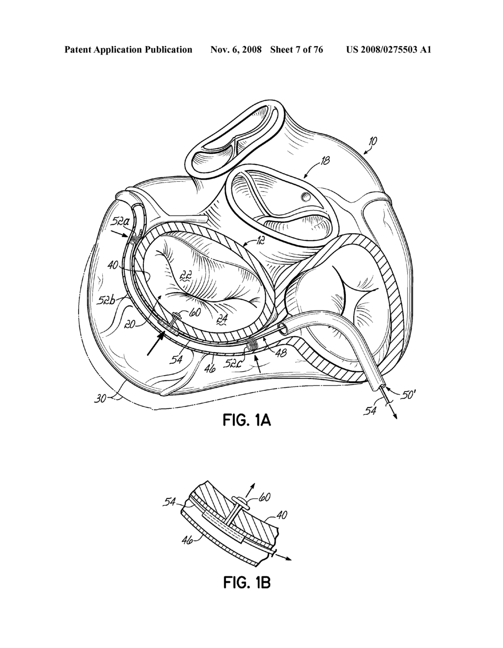 METHOD OF HEART VALVE REPAIR - diagram, schematic, and image 08