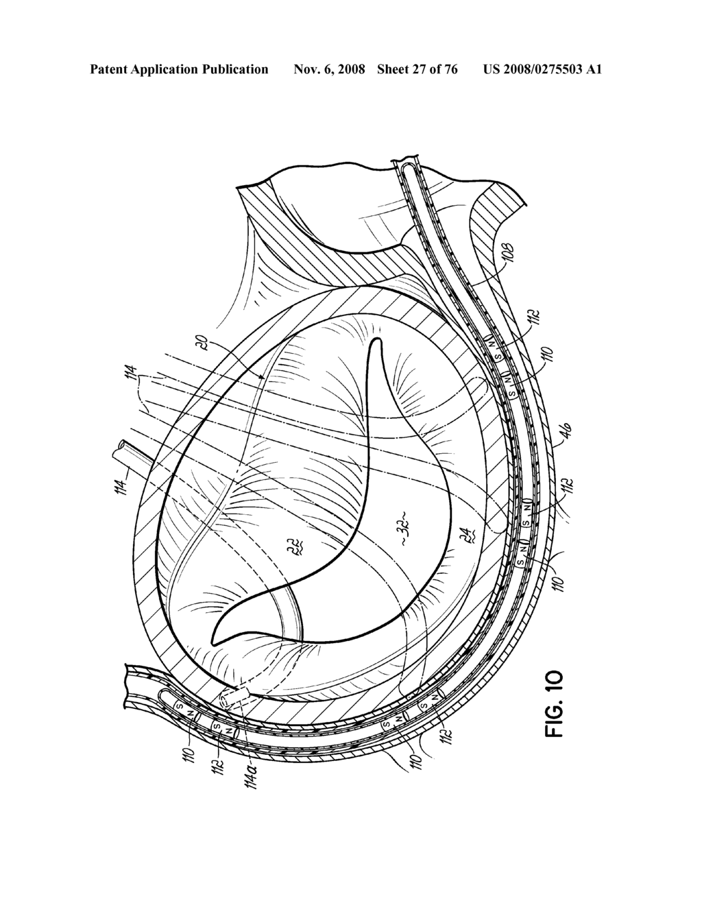 METHOD OF HEART VALVE REPAIR - diagram, schematic, and image 28