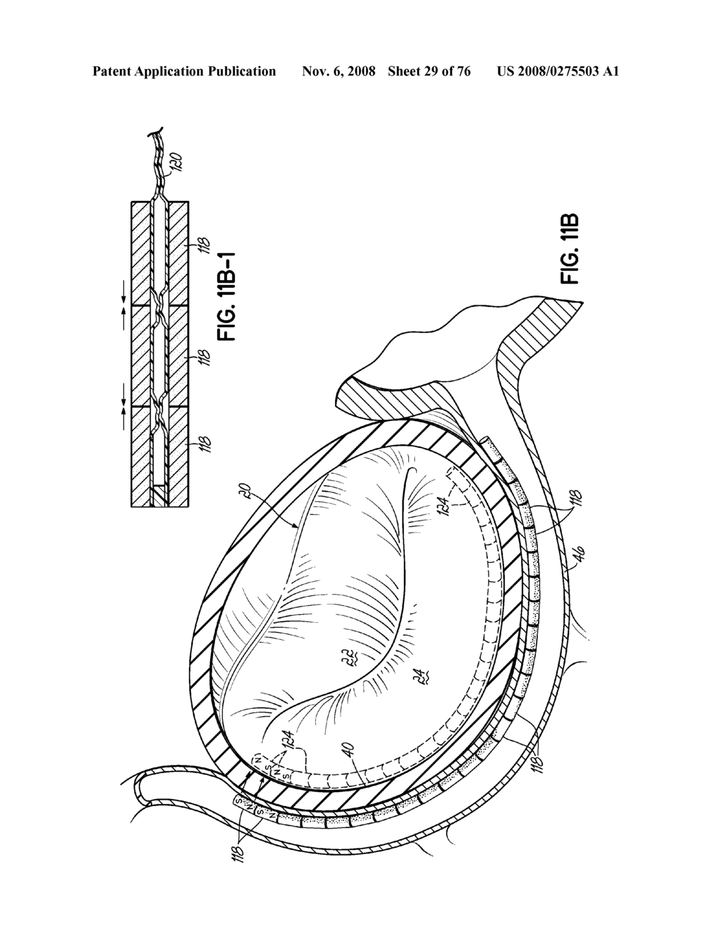 METHOD OF HEART VALVE REPAIR - diagram, schematic, and image 30