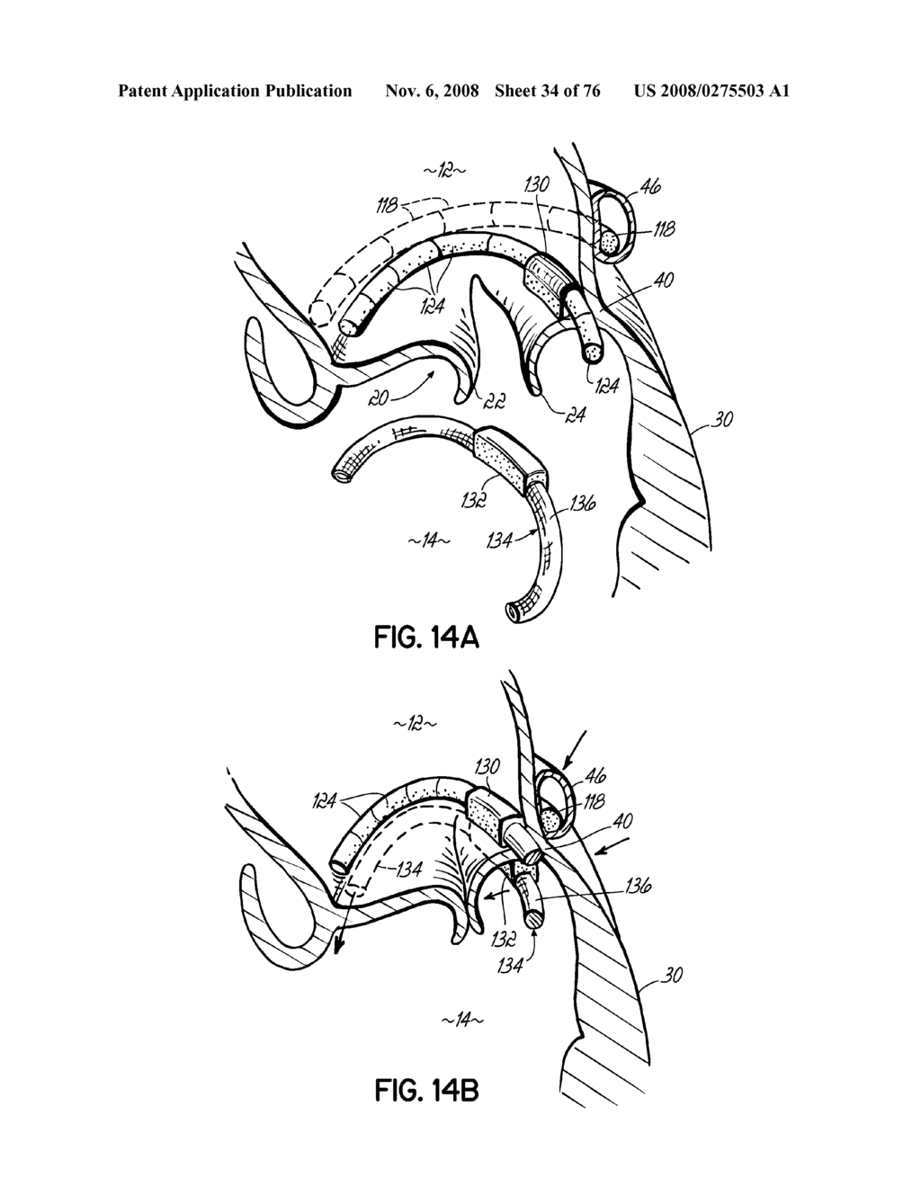 METHOD OF HEART VALVE REPAIR - diagram, schematic, and image 35