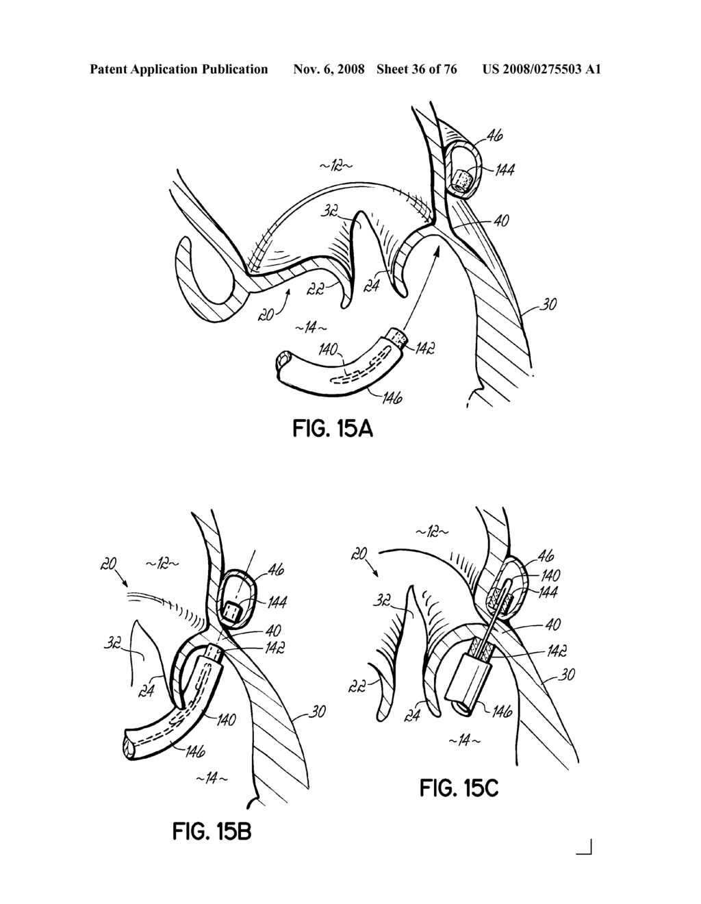 METHOD OF HEART VALVE REPAIR - diagram, schematic, and image 37