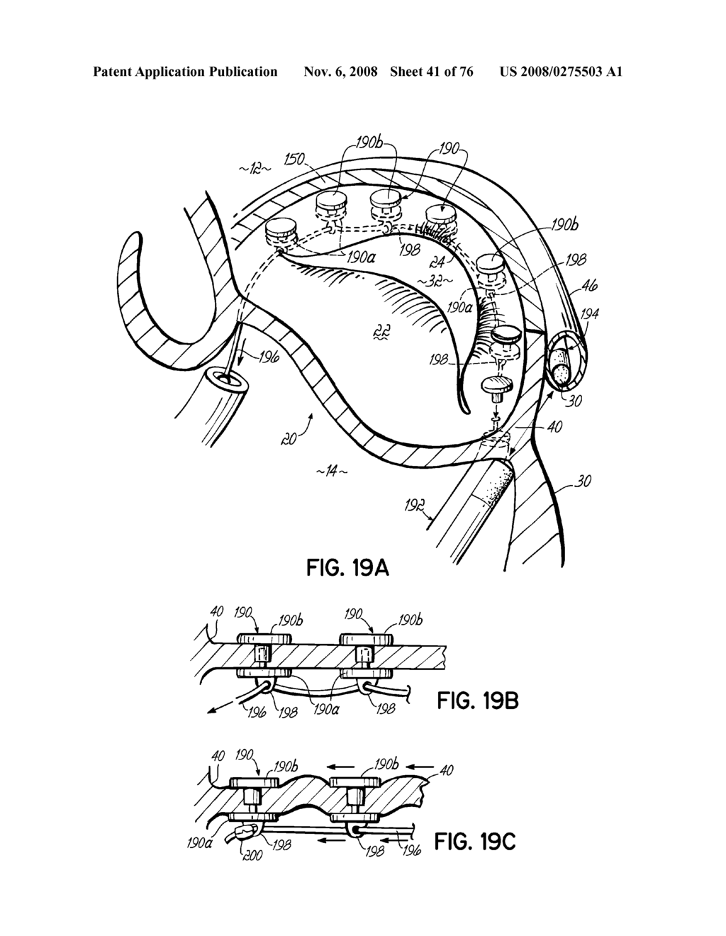 METHOD OF HEART VALVE REPAIR - diagram, schematic, and image 42