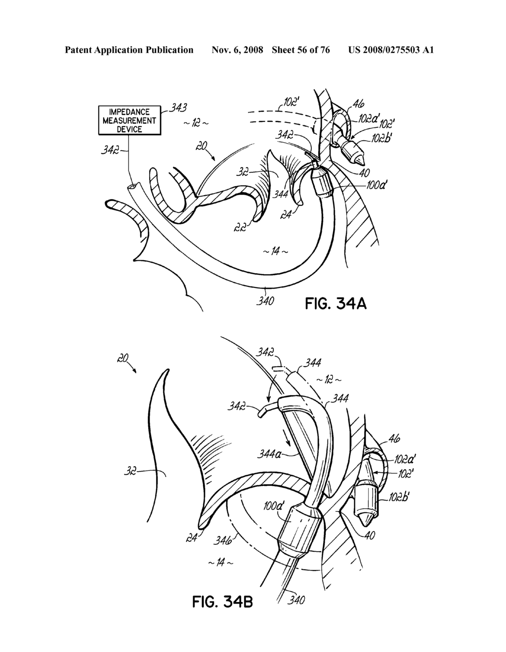 METHOD OF HEART VALVE REPAIR - diagram, schematic, and image 57