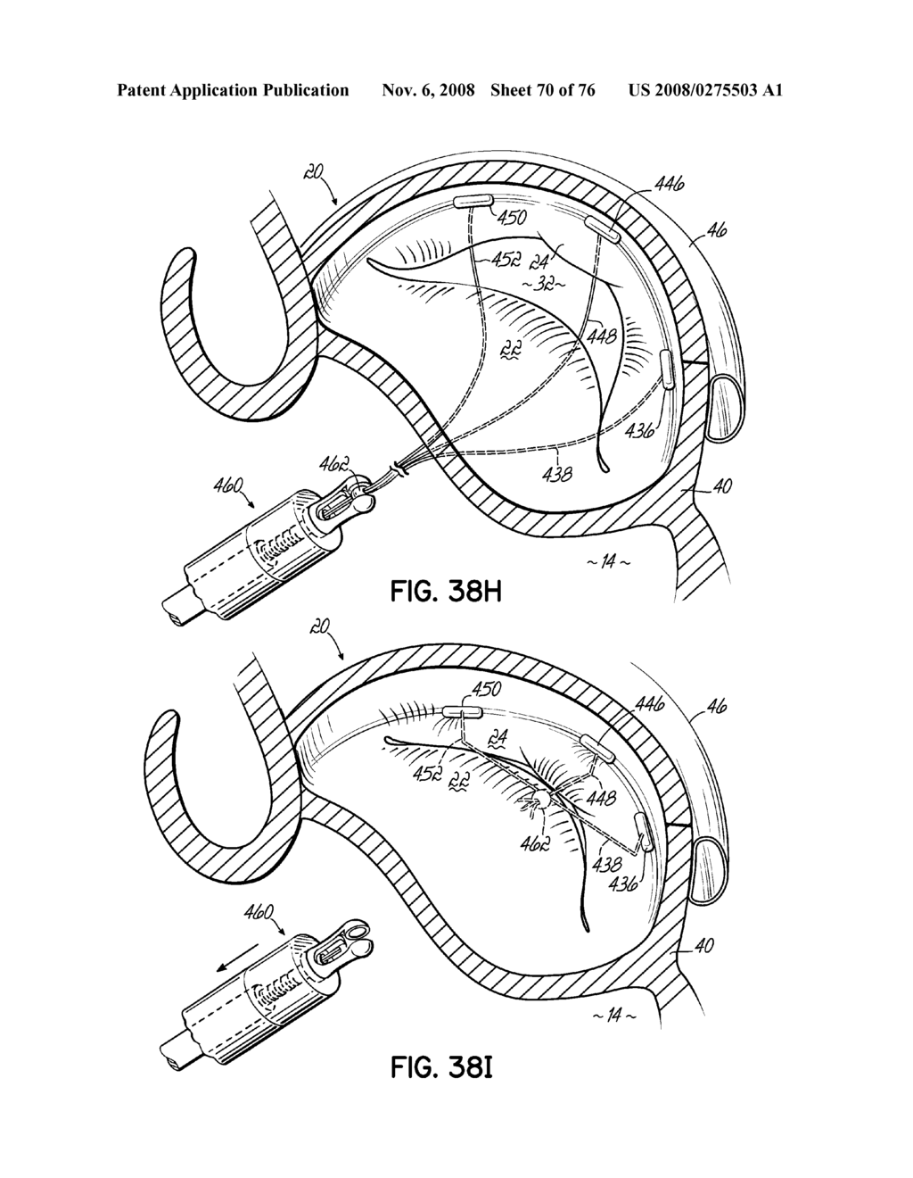 METHOD OF HEART VALVE REPAIR - diagram, schematic, and image 71