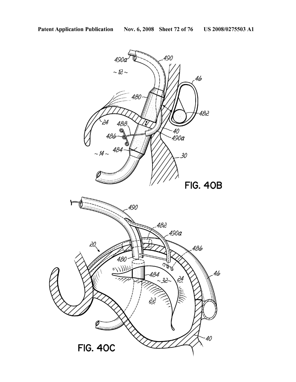 METHOD OF HEART VALVE REPAIR - diagram, schematic, and image 73