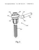 Facet Joint Replacement diagram and image