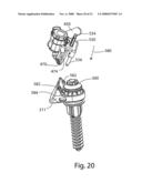 Facet Joint Replacement diagram and image