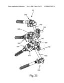 Facet Joint Replacement diagram and image