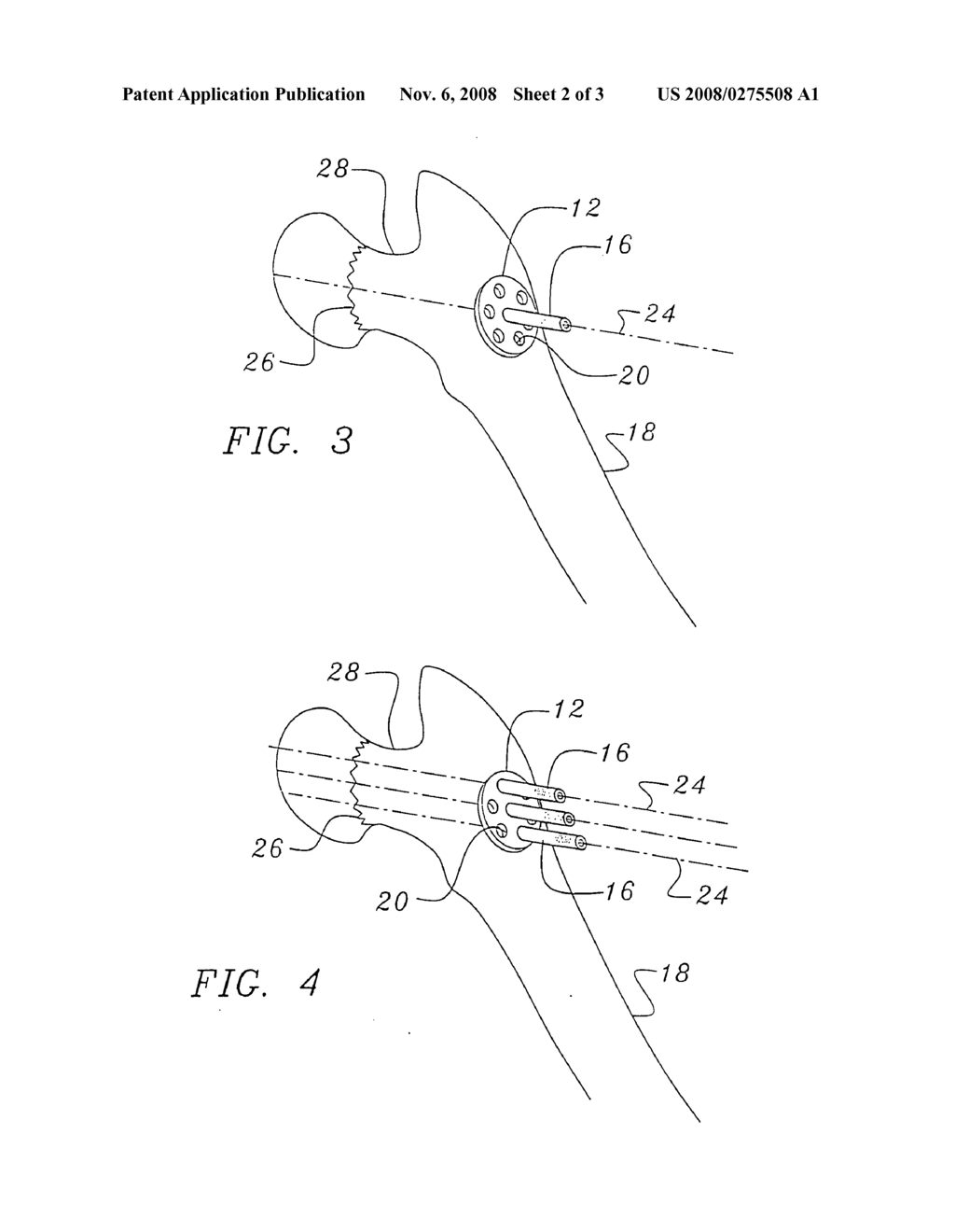 Bone end (epiphysis) fracture fixation device and method of use - diagram, schematic, and image 03