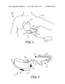 METHOD AND APPARATUS FOR DETECTING ARRHYTHMIAS IN A MEDICAL DEVICE diagram and image