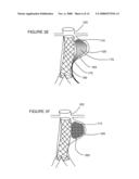 PREVENTION OF DISPLACEMENT OF PROSTHETIC DEVICES WITHIN ANEURYSMS diagram and image