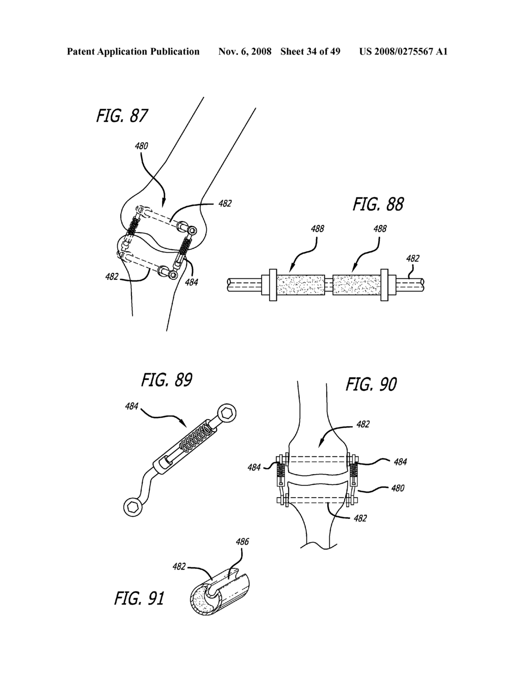 Extra-Articular Implantable Mechanical Energy Absorbing Systems - diagram, schematic, and image 35