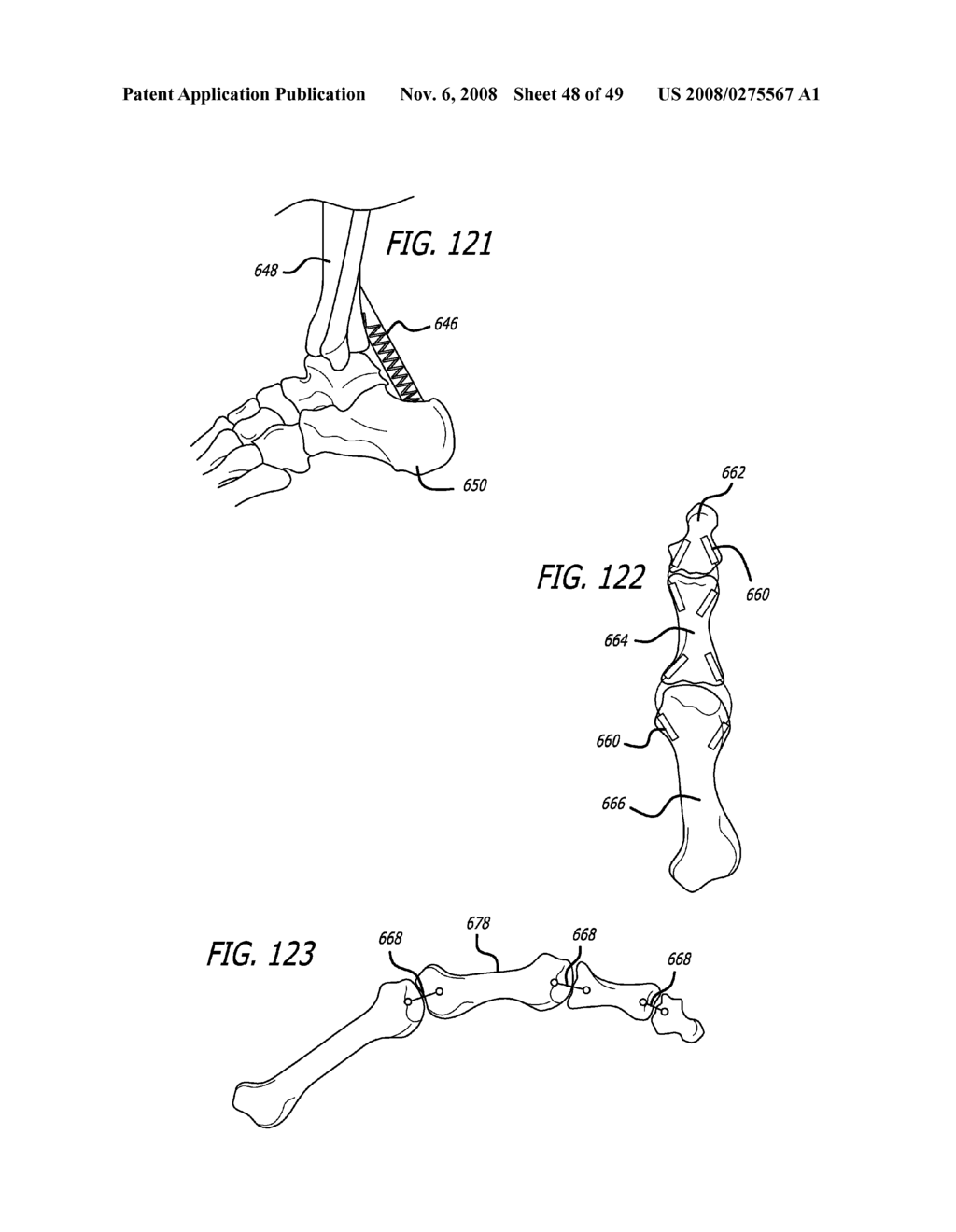 Extra-Articular Implantable Mechanical Energy Absorbing Systems - diagram, schematic, and image 49