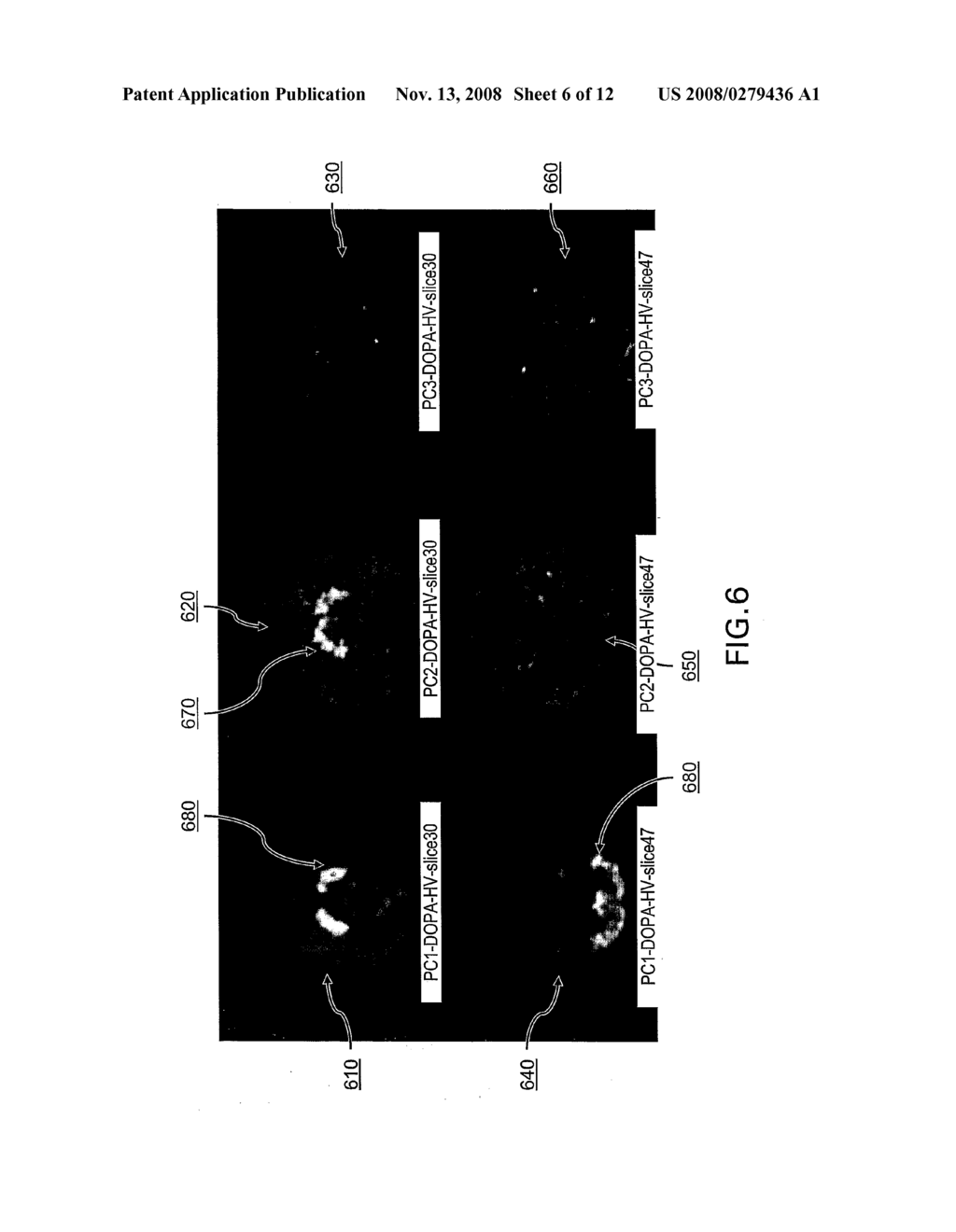 Method and System of Multivariate Analysis on Volume-Wise Data of Reference Structure Normalized Images for Improved Quality in Positron Emission Tomography Studies - diagram, schematic, and image 07