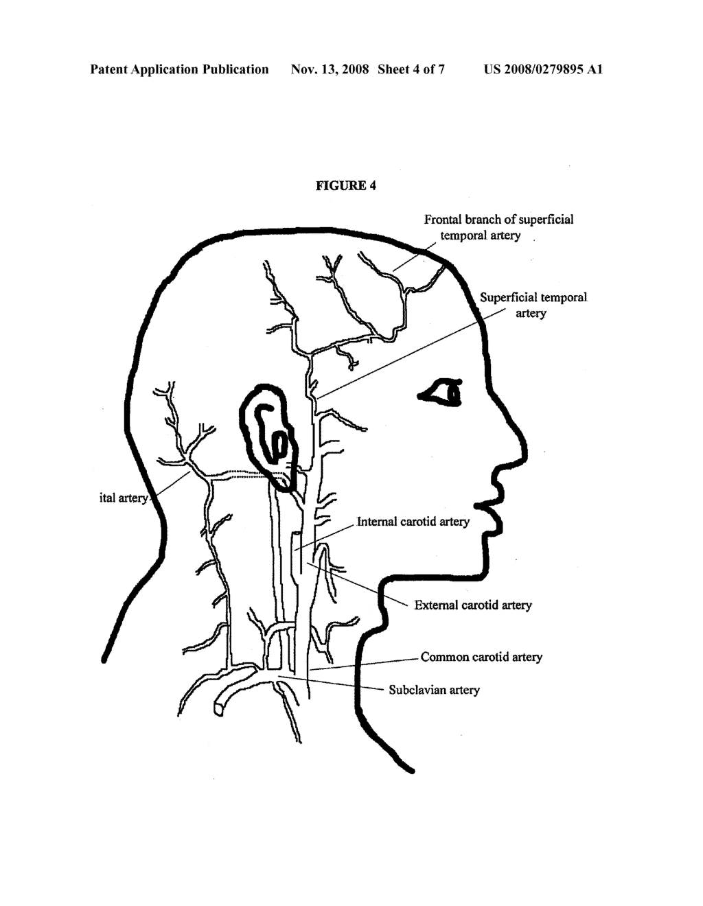 TARGETED DELIVERY OF BOTULINUM TOXIN TO THE SPHENOPALATINE GANGLION - diagram, schematic, and image 05