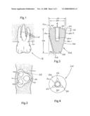 Molar Implant and Method diagram and image