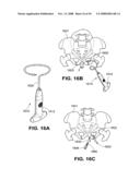 TRANSOBTURATOR INTRODUCER SYSTEM FOR SLING SUSPENSION SYSTEM diagram and image