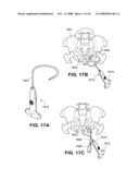 TRANSOBTURATOR INTRODUCER SYSTEM FOR SLING SUSPENSION SYSTEM diagram and image