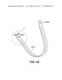 TRANSOBTURATOR INTRODUCER SYSTEM FOR SLING SUSPENSION SYSTEM diagram and image