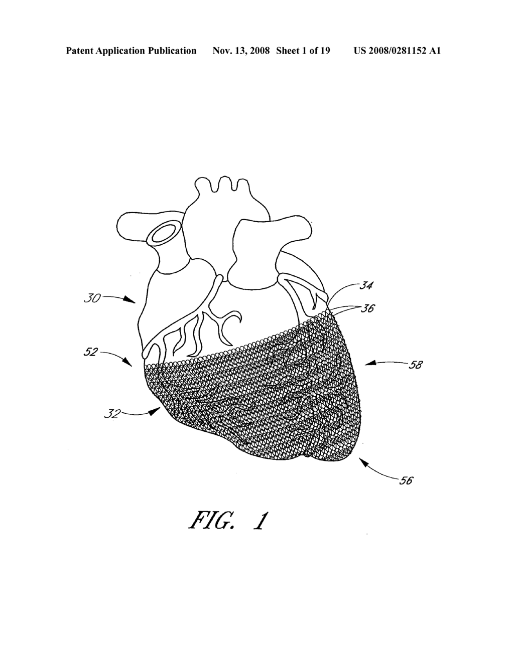 HEART FAILURE TREATMENT DEVICE AND METHOD - diagram, schematic, and image 02