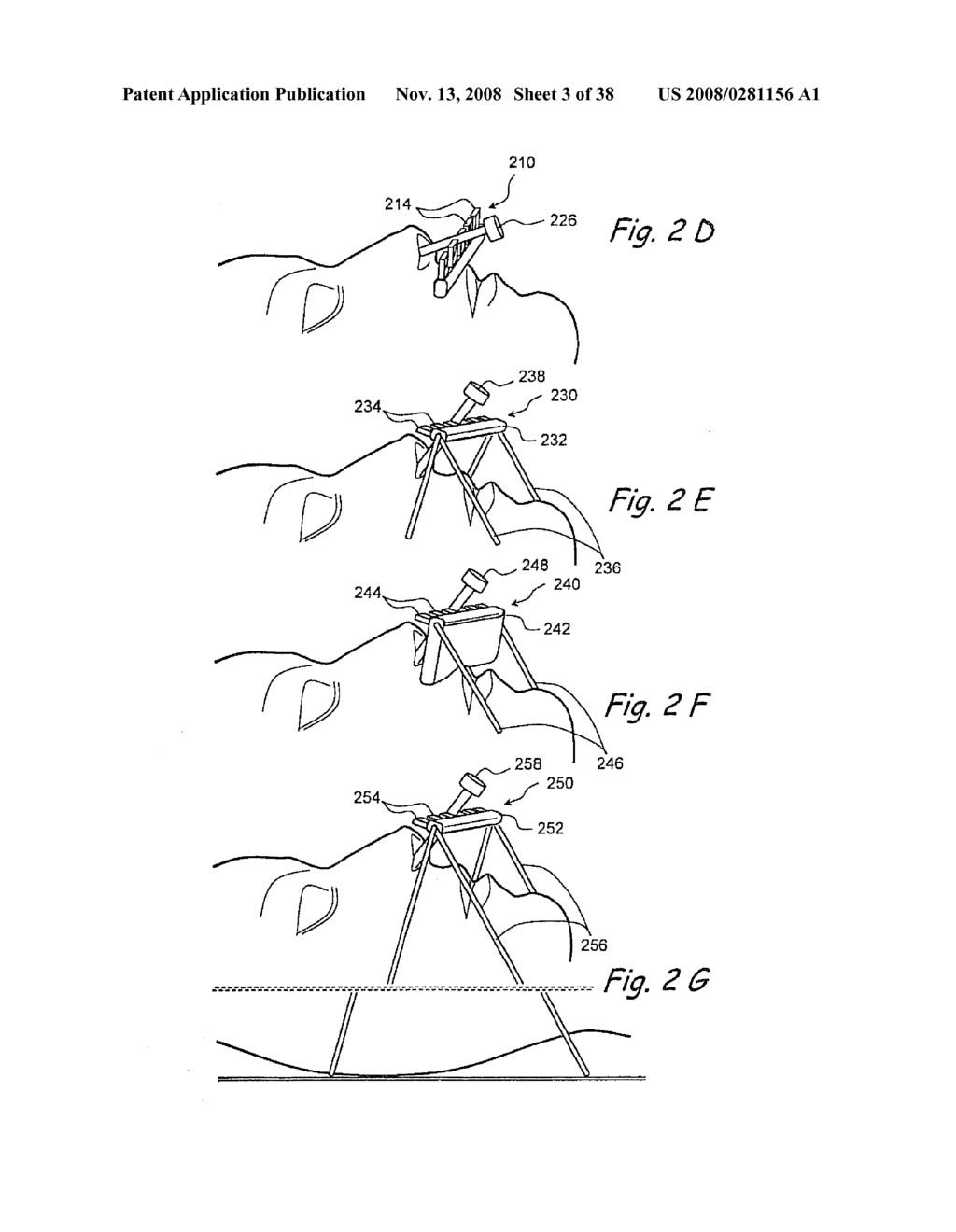 Methods and Apparatus for Treating Disorders of the Ear Nose and Throat - diagram, schematic, and image 04