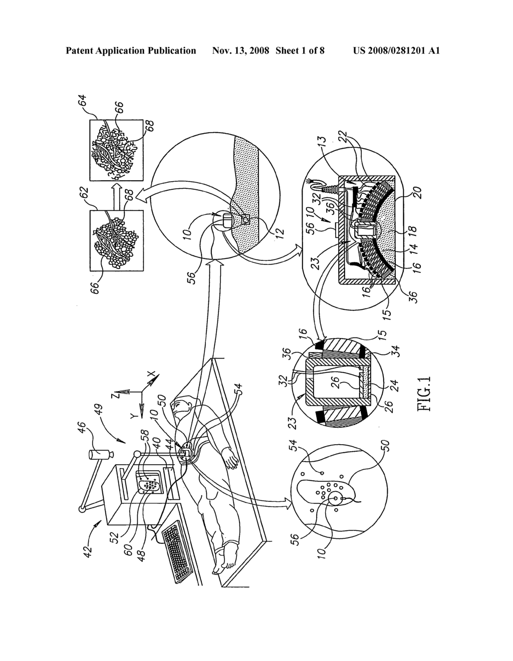 Non-invasive ultrasonic body contouring - diagram, schematic, and image 02