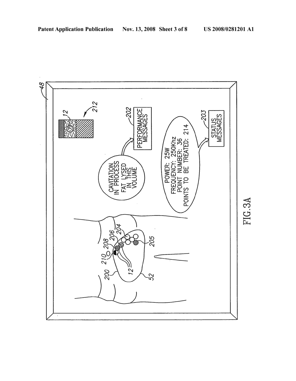 Non-invasive ultrasonic body contouring - diagram, schematic, and image 04